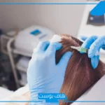 تجربتي مع حقن البلازما للشعر والنتيجة.. نصائح قبل حقن البلازما للشعر
