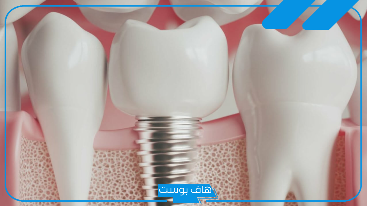 تجربتي مع زراعة الأسنان كاملة.. هل زراعة الأسنان تؤلم؟