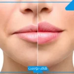 تجربتي مع فيلر جوفيديرم للشفايف بالفوائد والأضرار