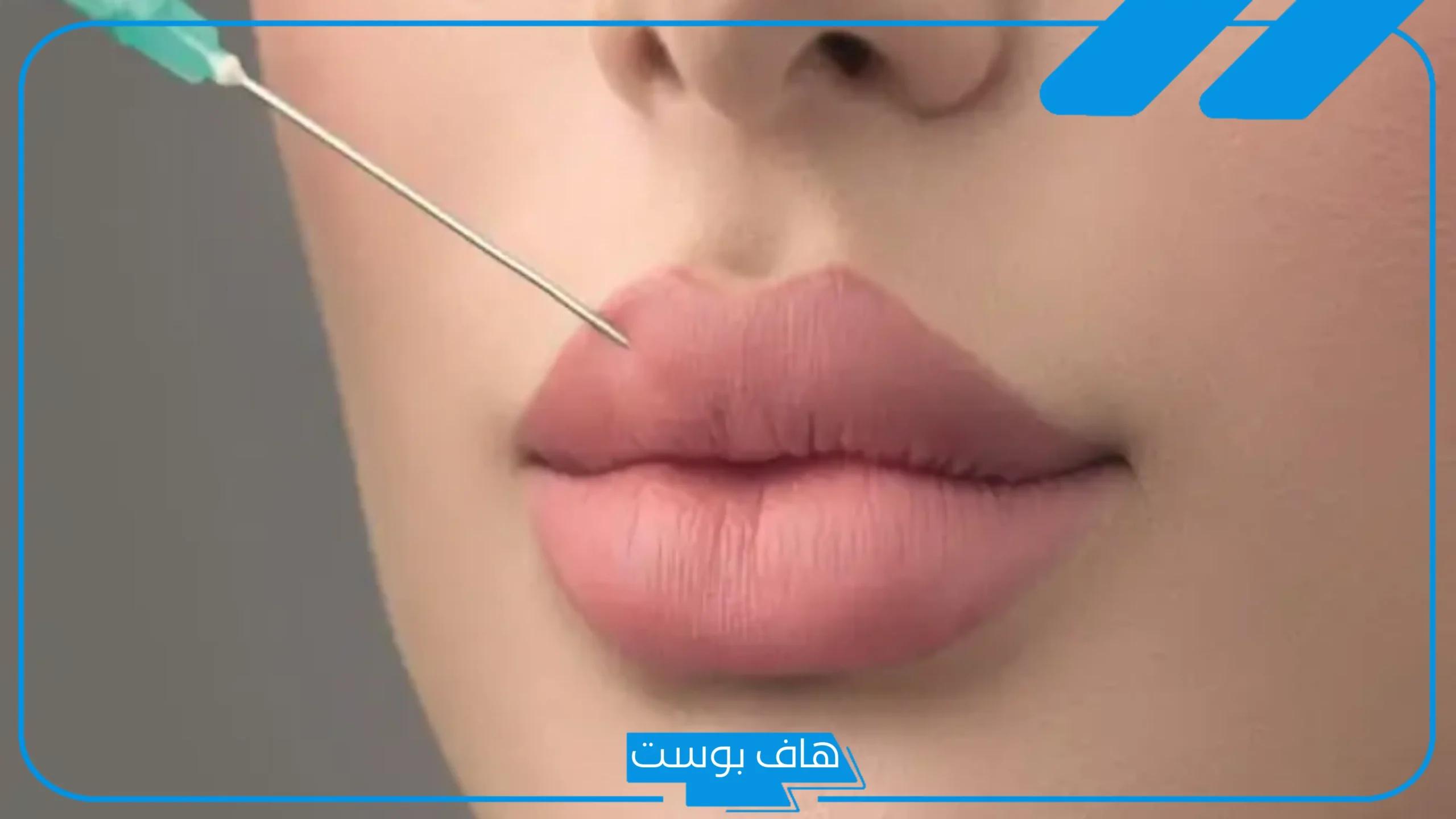 تجربتي مع فيلر جوفيديرم للشفايف بالفوائد والأضرار