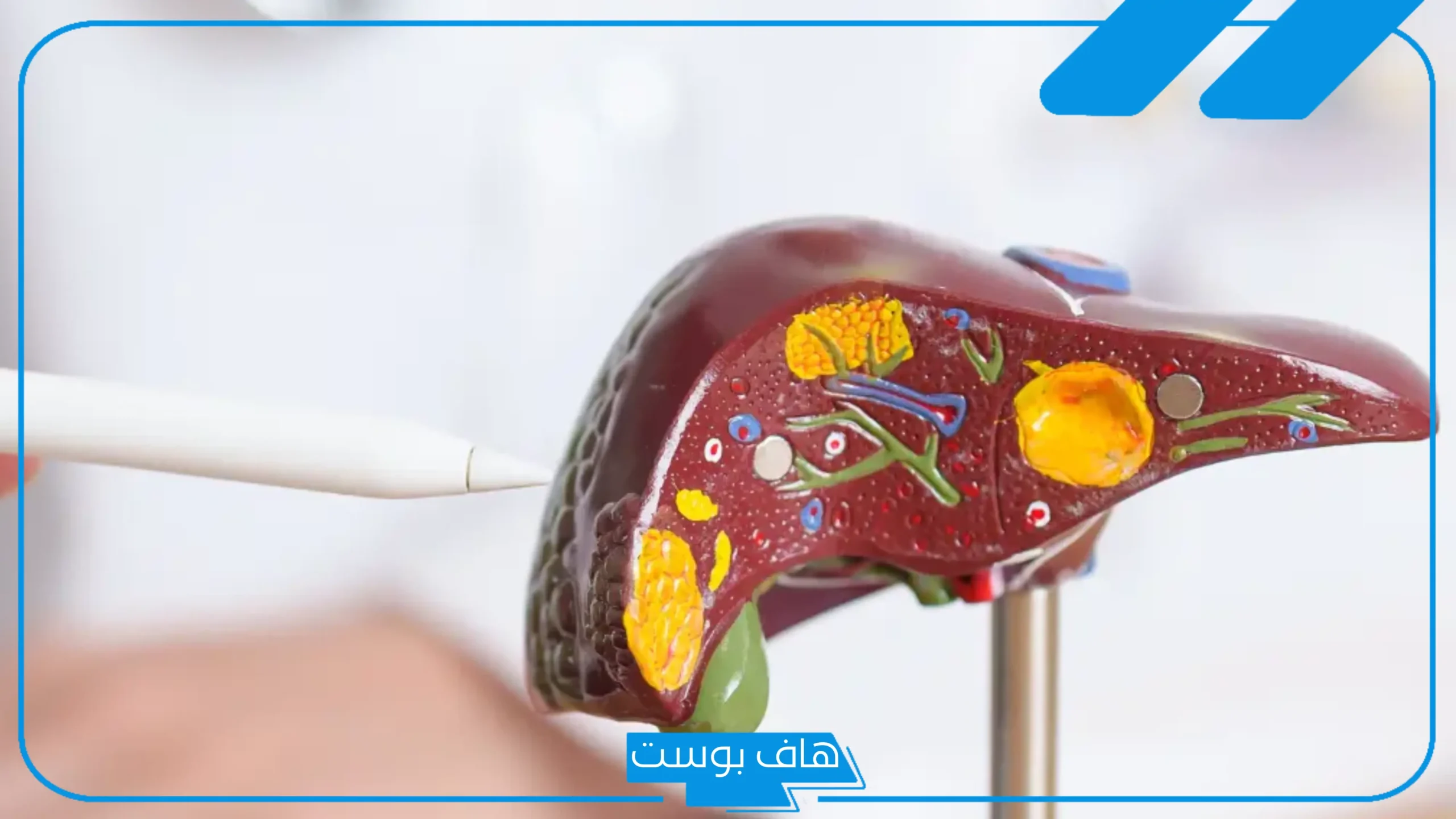 تجربتي في إزالة دهون الكبد.. أسهل طريقة لإزالة دهون الكبد بالأعشاب