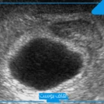 تجربتي مع الحمل بكيس بدون جنين بالأعراض.. إفرازات كيس الحمل الفارغ
