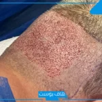 تجربتي مع التهاب بصيلات الشعر وطرق العلاجية المنزلية.. أنواع التهاب بصيلات الشعر 