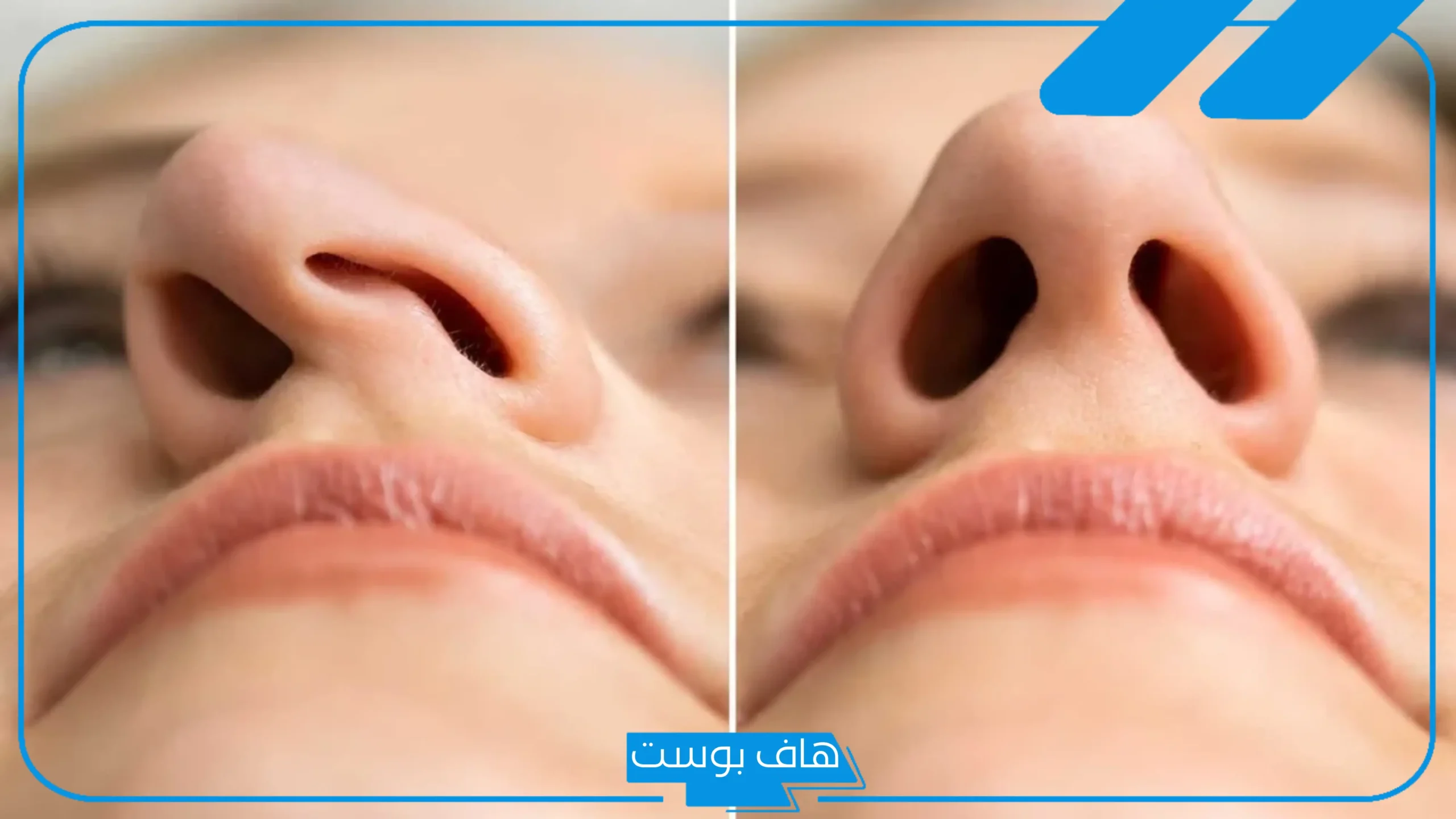 تجربتي مع عملية تجميل الانف.. هل عملية تجميل الأنف تسبب الوفاة؟