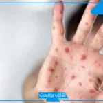 بعد ارتفاع إصابات الحصبة.. تحذيرات أمريكية من وباء عالمي!