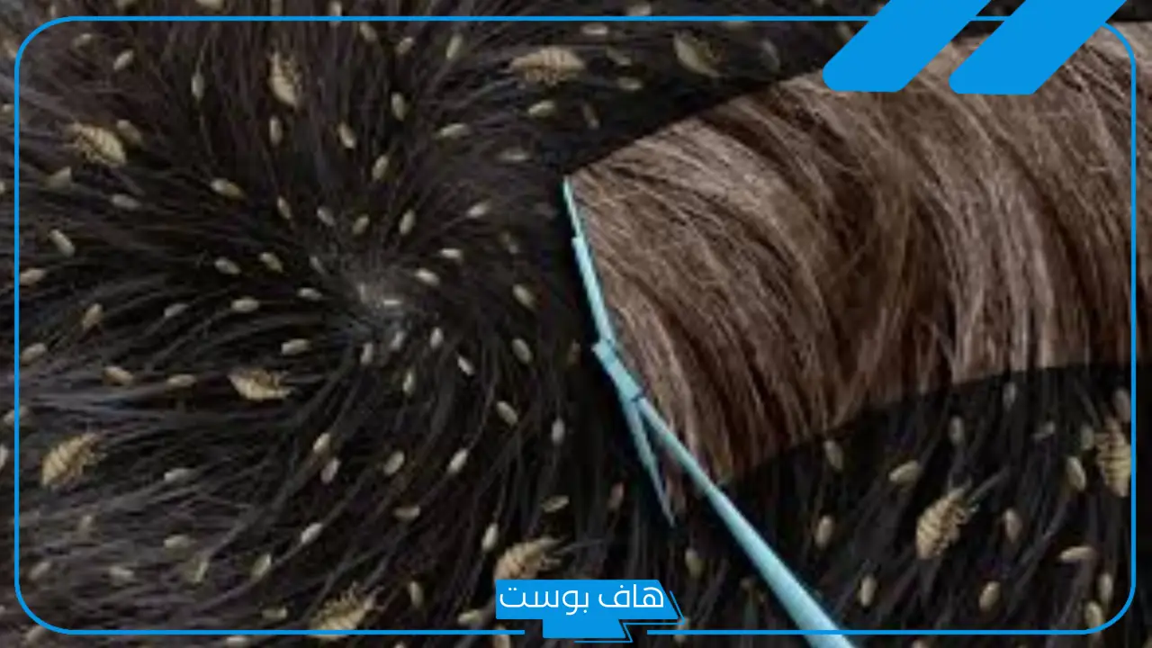 تفسير حلم القمل للمتزوجة والحامل والعزباء في شعر شخص آخر في المنام