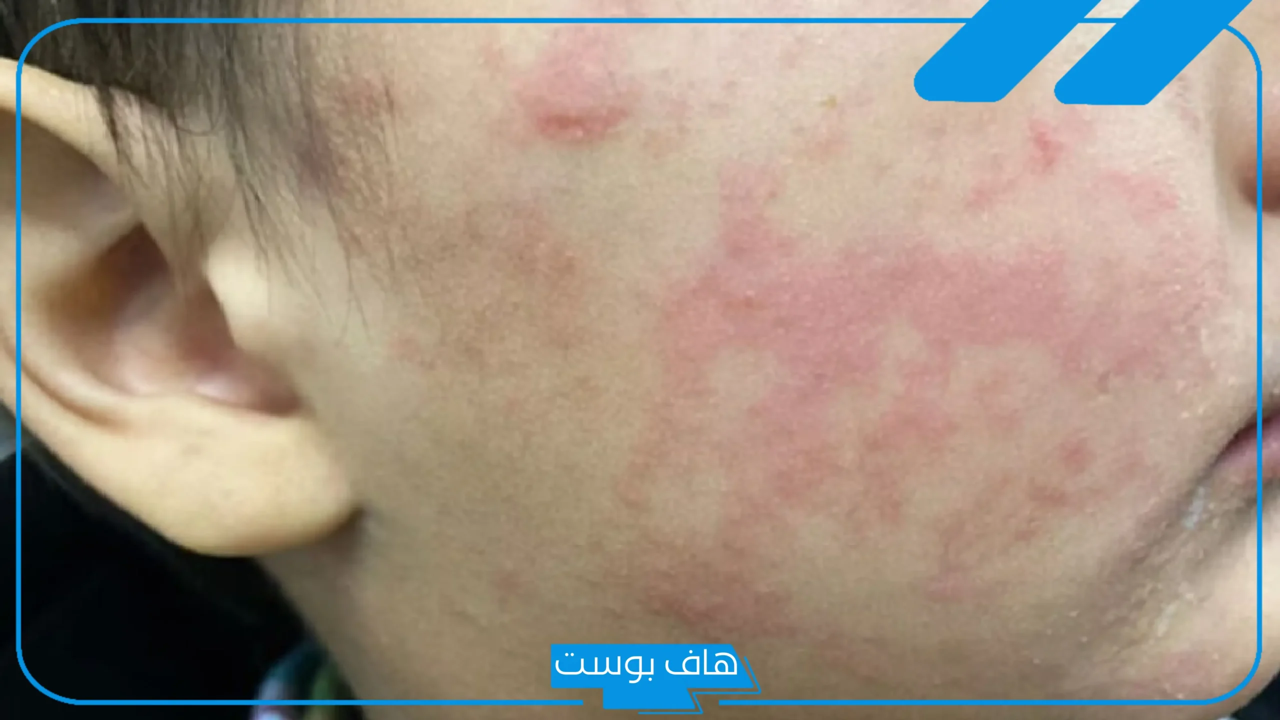 بعد ارتفاع إصابات الحصبة.. تحذيرات أمريكية من وباء عالمي!