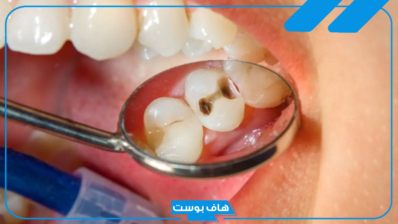 تفسير حلم وقوع الضرس في المنام للرجل والمرأة دون ألم ودم