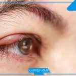 تفسير حلم العين المصابة في المنام للرجل والمرأة