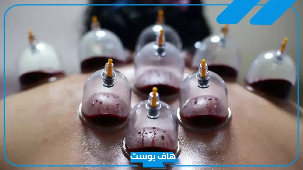 أهم فوائد الحجامة للعين كاملة، علامات خروج العين والحسد بالحجامة
