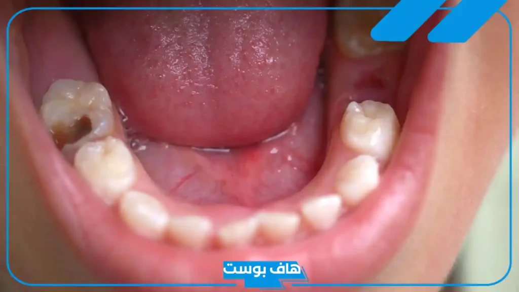 تفسير حلم كسر الضرس في المنام وسقوطه للرجل والمرأة المتزوجة