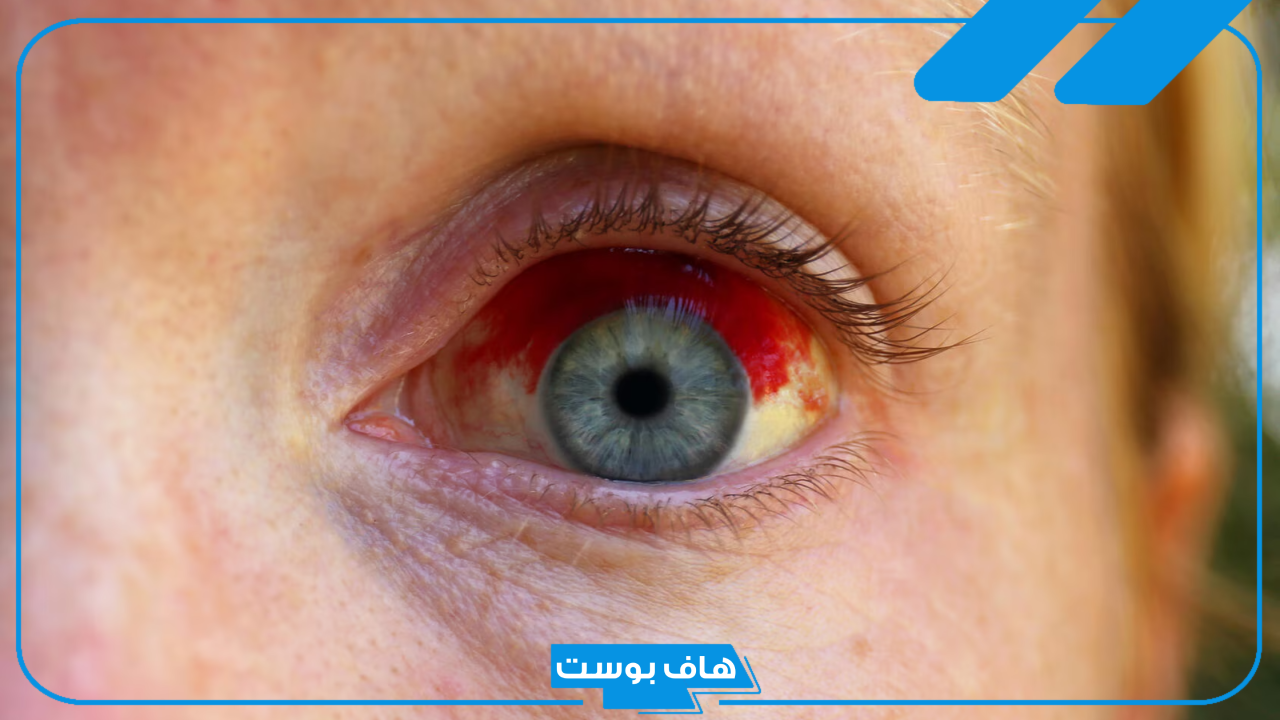 تفسير حلم فقدان عين واحدة في المنام للحامل والمتزوجة والرجل
