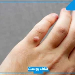 تفسير حلم رؤية الثآليل في المنام للعزباء والمتزوجة لابن سيرين