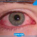 تفسير حلم فقدان عين واحدة في المنام للحامل والمتزوجة والرجل