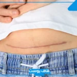 تفسير حلم شق البطن في المنام للحامل والمطلقة والمتزوجة