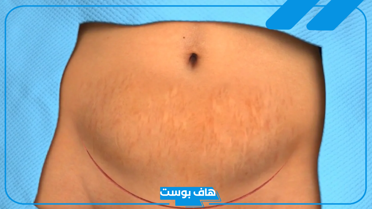 تفسير حلم شق البطن في المنام للحامل والمطلقة والمتزوجة
