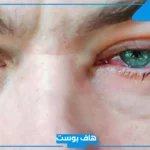 تفسير حلم العين المصابة في المنام للرجل والمرأة
