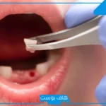 تفسير رؤية سقوط الضرس في المنام بدون دم وألم لابن سيرين