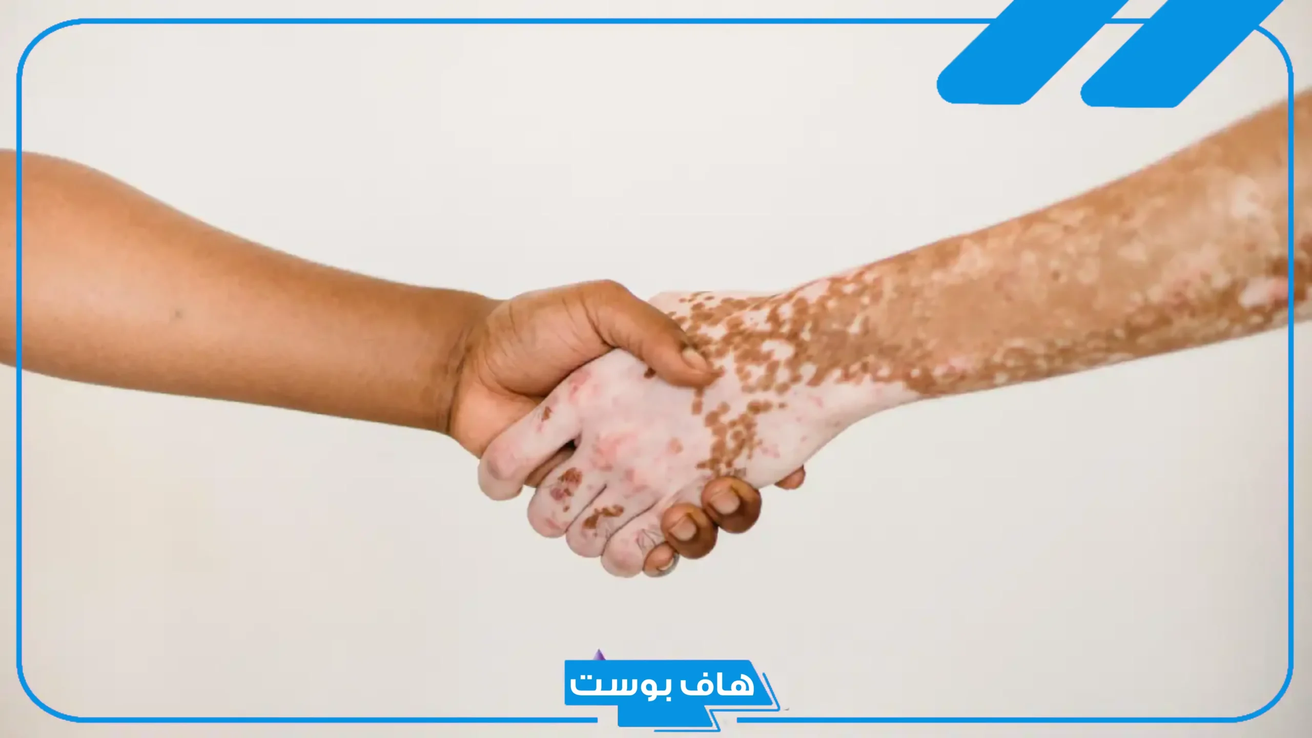 تفسير حلم البهاق في المنام للعزباء و للمتزوجة لابن سيرين