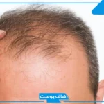 تفسير حلم الصلع في جزء من الرأس في المنام لابن سيرين للرجل المتزوج