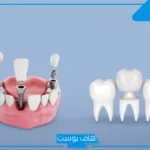 تفسير حلم تركيب الاسنان في المنام للرجل والمرأة المتزوجة لابن سيرين