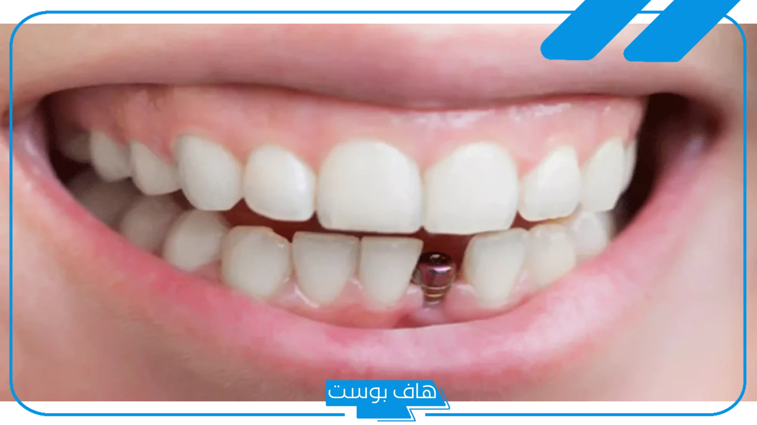 تفسير حلم تركيب الاسنان في المنام للرجل والمرأة المتزوجة لابن سيرين