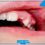تفسير حلم سن مكسور أمامي بدون دم في المنام عند ابن سيرين