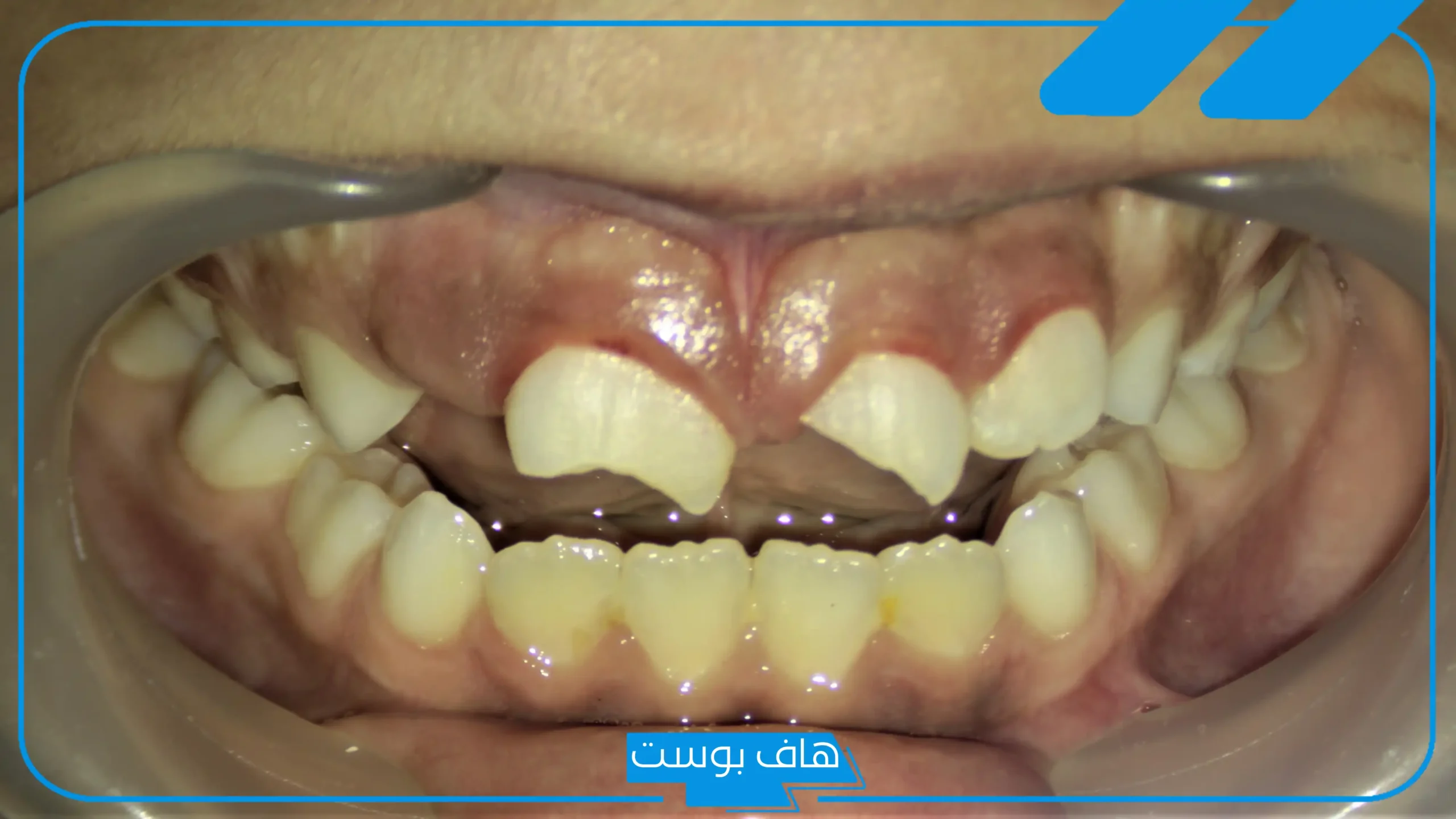 تفسير حلم سن مكسور أمامي بدون دم في المنام عند ابن سيرين