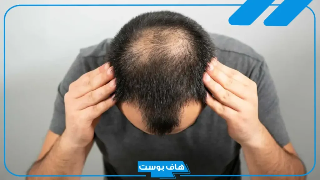 تفسير حلم الصلع في جزء من الرأس في المنام لابن سيرين للرجل المتزوج