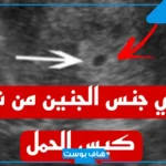 شكل كيس الجنين ونوعه بالصور.. تجربتي مع شكل كيس الحمل