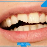 تفسير حلم تسوس الاسنان في المنام السفلية والأمامية للرجل والمرأة العزباء