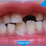 تفسير حلم تكسر الاسنان من السن العلوي في المنام لابن سيرين