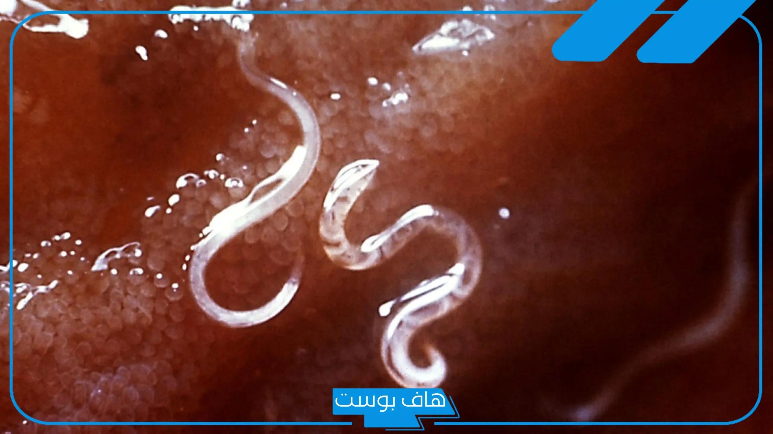 تفسير حلم رؤية ديدان في البراز المنام وخروجه من الجسم لابن سيرين