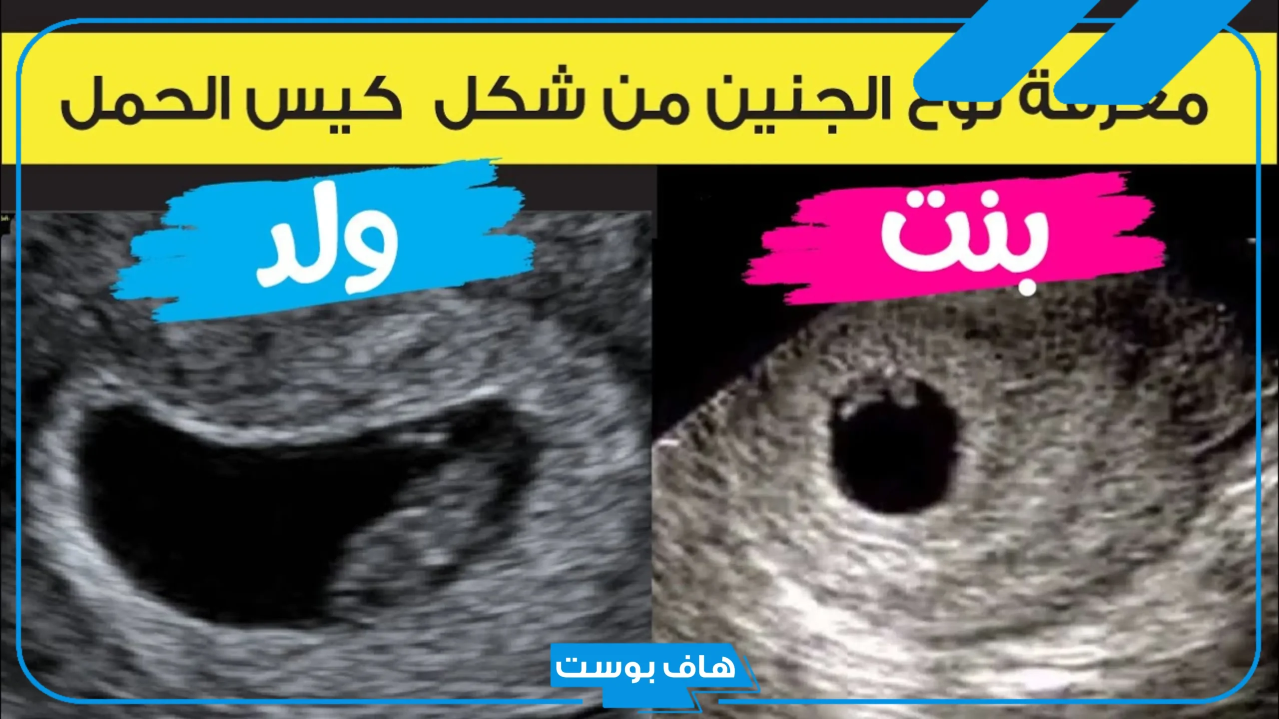 شكل كيس الجنين ونوعه بالصور.. تجربتي مع شكل كيس الحمل