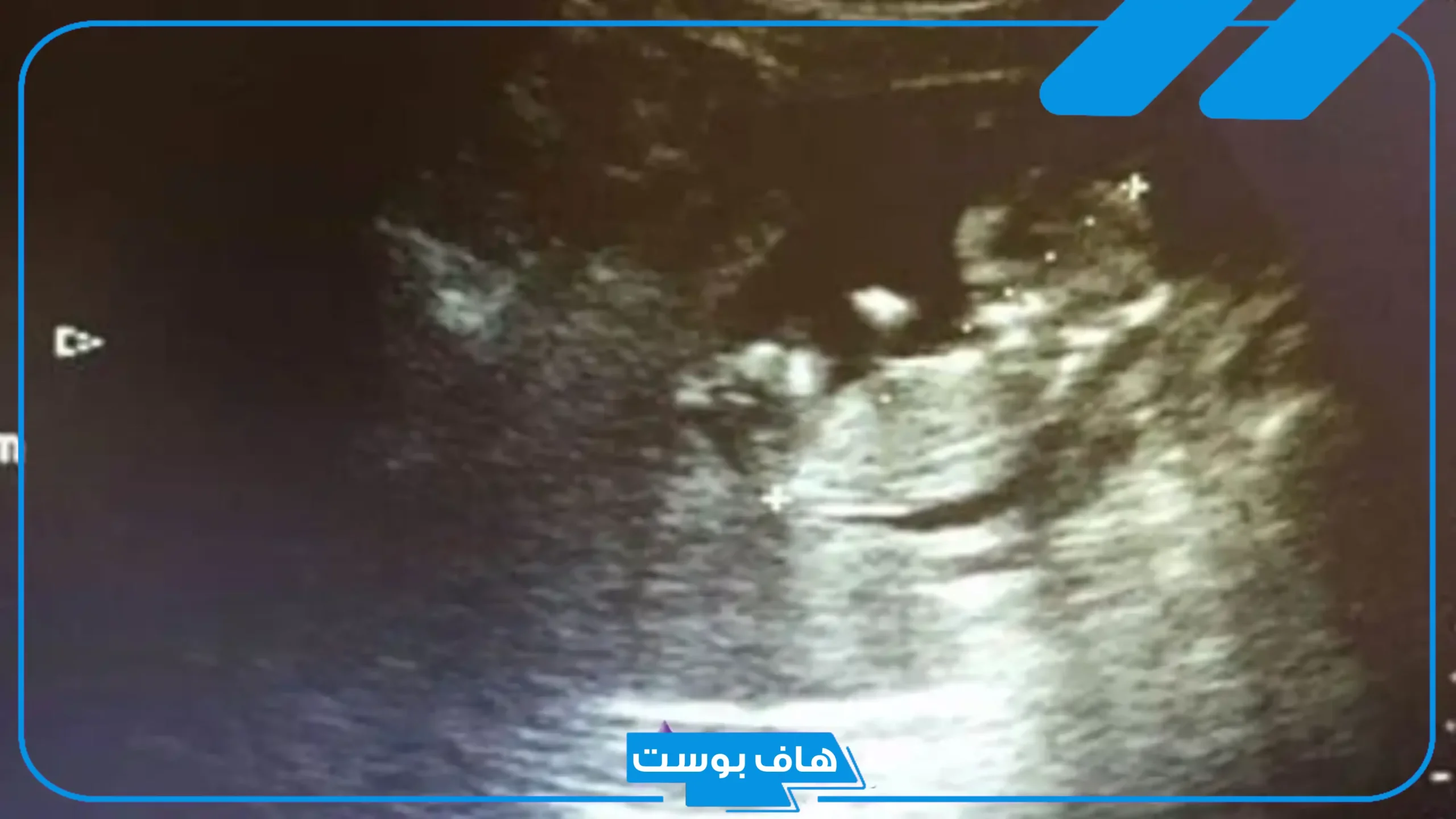 شكل كيس الجنين ونوعه بالصور.. تجربتي مع شكل كيس الحمل