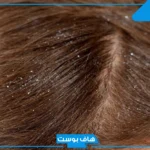 تفسير رؤية القمل في الحلم لابن شاهين وابن سيرين لشخص آخر