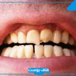 تفسير رؤية حلم تكسر الاسنان في المنام لابن سيرين للعزباء والمتزوجة