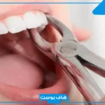 تفسير رؤية خلع الضرس في المنام للمتزوجة باليد لابن سيرين