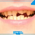 تفسير رؤية تكسر الاسنان في المنام وسقوطها للعزباء والحامل لابن سيرين 