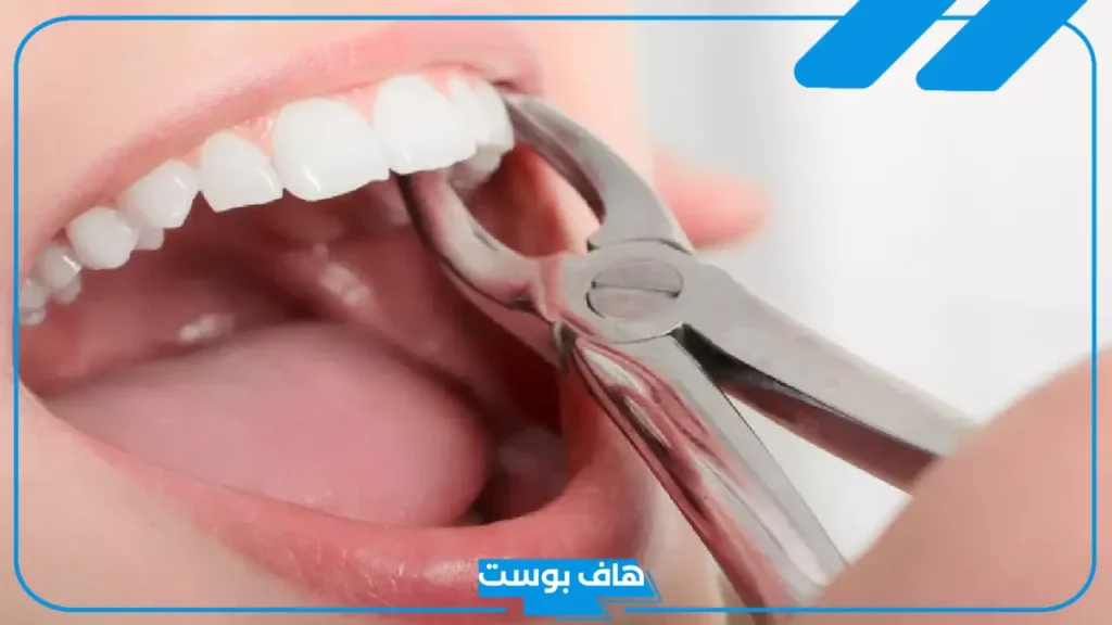 تفسير رؤية خلع الضرس في المنام للمتزوجة والعزباء لابن سيرين