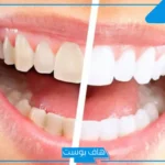 تفسير حلم رؤية السن في المنام وسقوطه وكسره لابن سيرين
