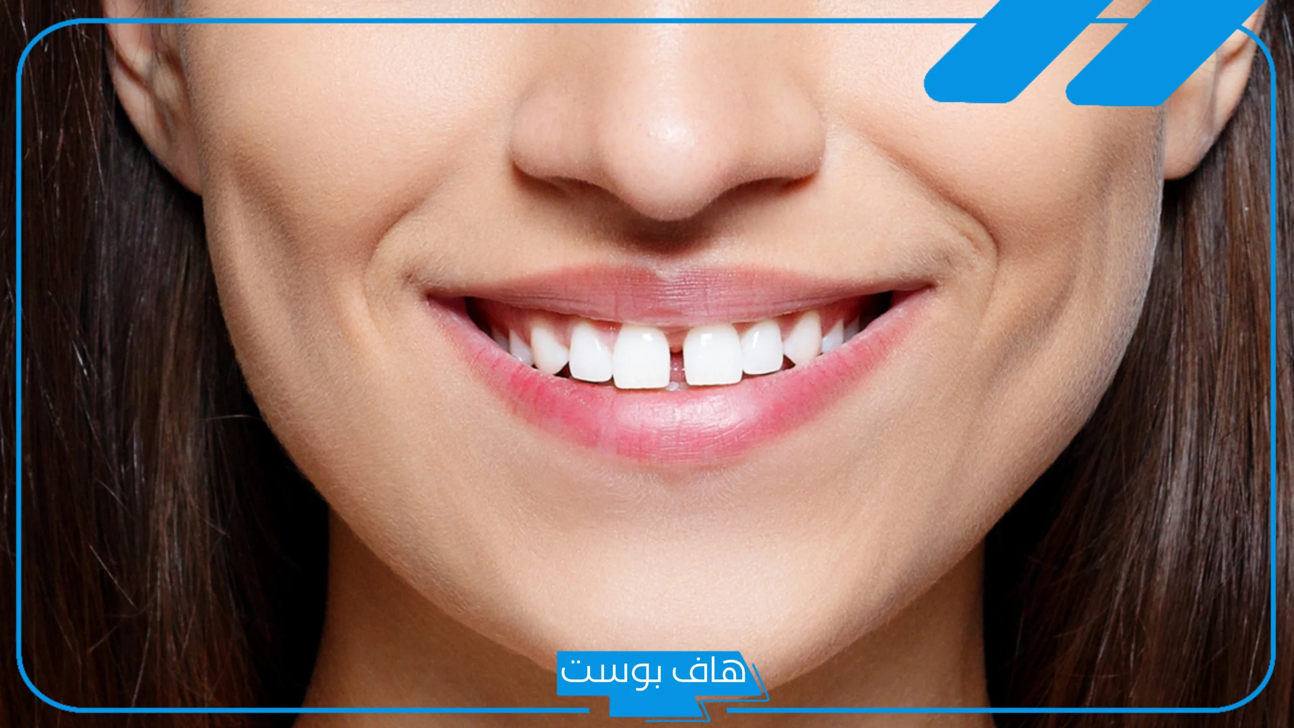تفسير حلم الاسنان الامامية متفرقة للمتزوجه والمطلقة والرجل لابن سيرين