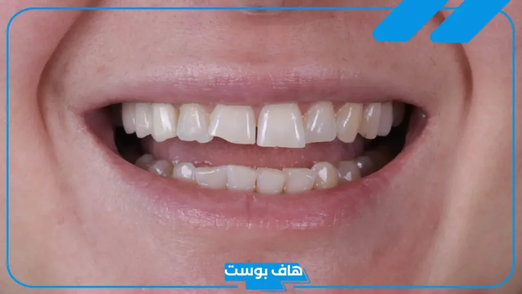 تفسير حلم كسر الاسنان الأمامية والسفلية بدون دم في المنام لابن سيرين