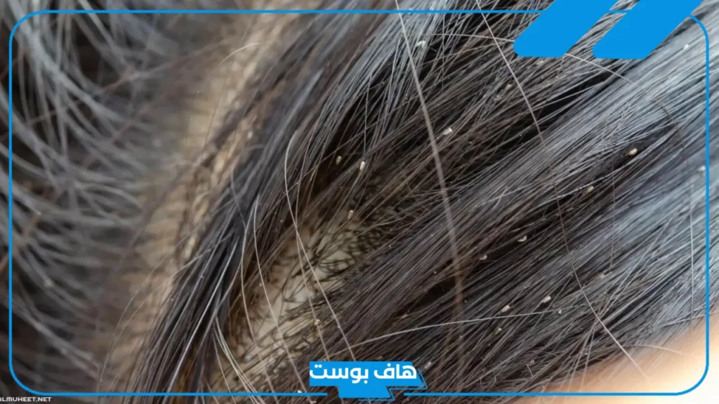 تفسير حلم القمل بالشعر وقتله في المنام لابن سيرين للعزباء