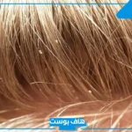 تفسير حلم القمل بالشعر وقتله في المنام لابن سيرين للعزباء