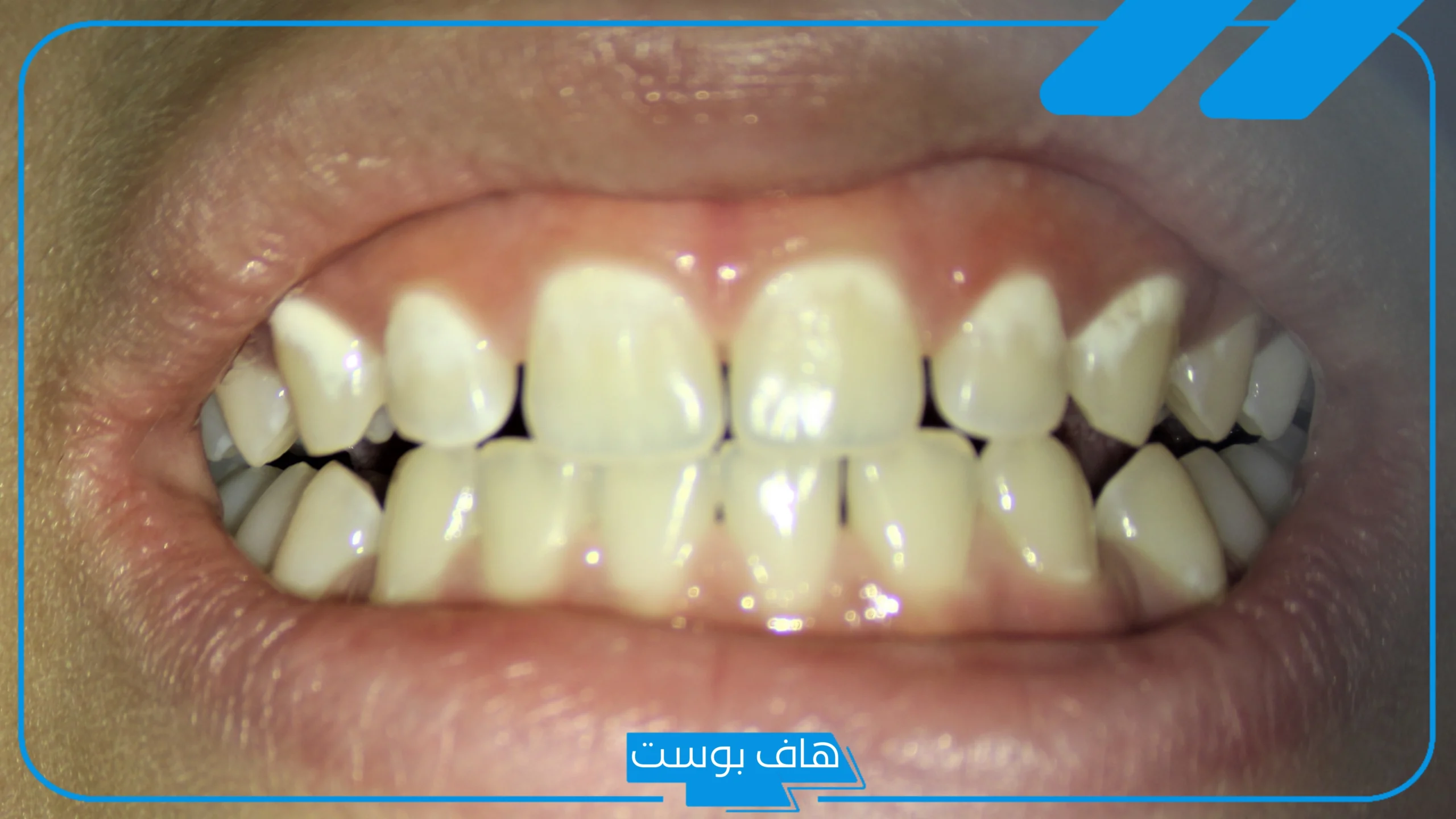 تفسير حلم تسوس الاسنان السفلية والأمامية في المنام لابن سيرين
