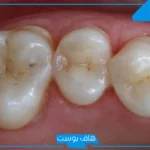 تفسير حلم تسوس الاسنان السفلية والأمامية في المنام لابن سيرين