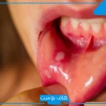 تفسير حلم خروج الدم من الفم في المنام بعد الرقية للرجل لابن سيرين