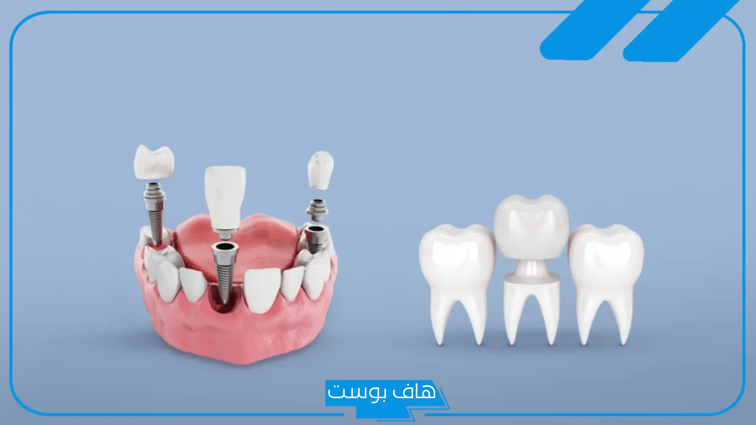 تفسير حلم خلع الضرس باليد مع نزول دم في المنام للرجل لابن سيرين