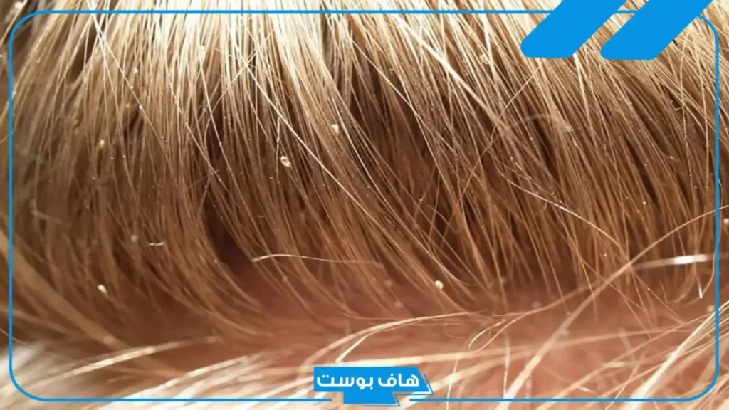 تفسير حلم اخراج القمل من الشعر في المنام وقتله لابن سيرين
